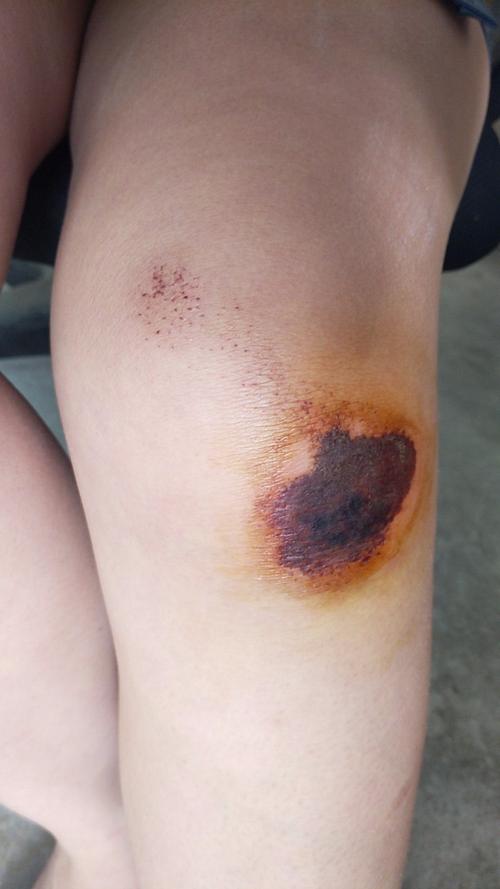 膝盖摔伤3天了,有点红肿怎么办?