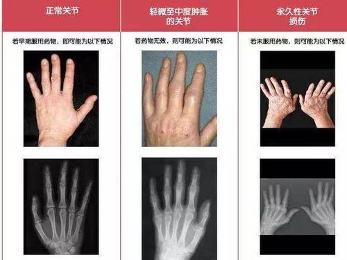 一定要检查这几种疾病|肿胀|关节炎