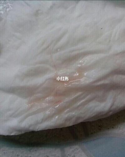 1,霉菌性阴道炎:又称为外阴阴道假丝酵母菌病,主要表现为外阴瘙痒