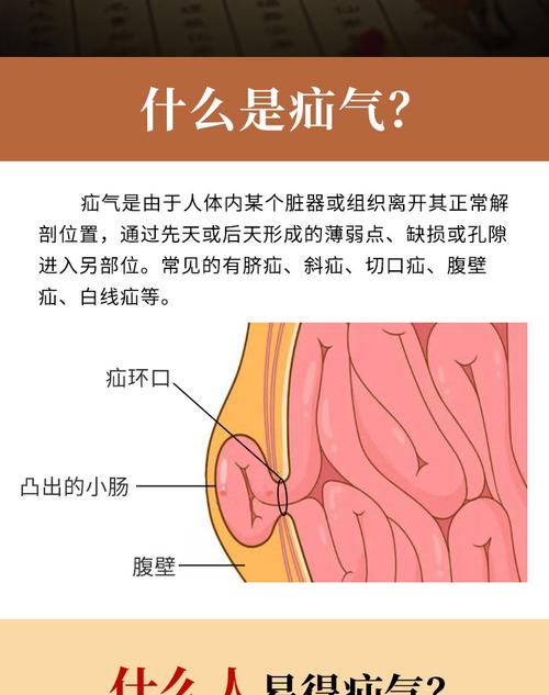 金古圣方疝气贴药膏脐疝儿童老人老年腹股沟疝切口疝