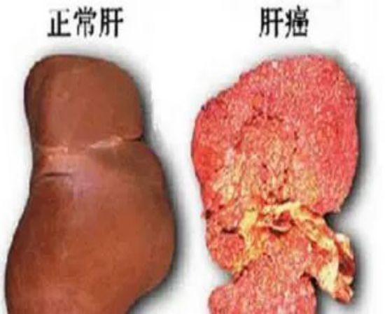 男性出现"3臭1痛",可能肝已烂透,若没有出现说明肝还"