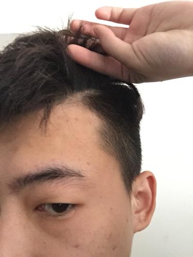 追问 我这不是脂溢性脱发吧? 回答