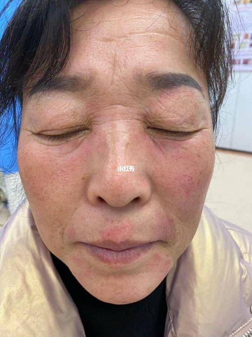 面部反复红斑伴轻微瘙痒半年, 这是一个典型的脂溢性皮炎 临床特点