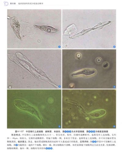 其它 18检验二班杜蓉蓉 尿液中的细胞及其他 写美篇 底层移行上皮细胞