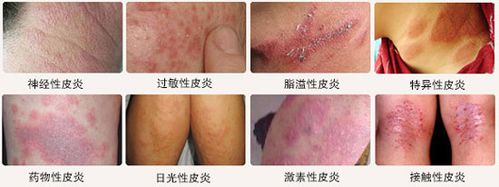 包括常见的夏季皮炎,隐翅虫皮炎,脂溢性皮炎,日光性皮炎,药物性皮炎