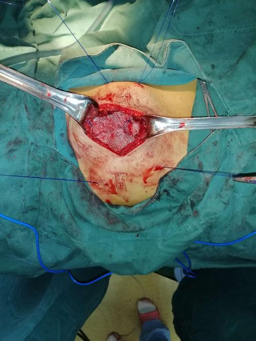 与思考: 本例病人病因明确,是由于外伤导致肌肉薄弱,从而引起腰部薄弱