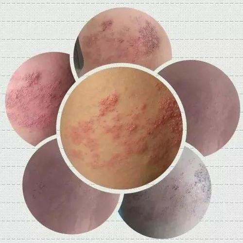 疱疹病毒俗称生飞蛇,患处皮肤潮红,后期进而出现多数成群簇集的丘疱疹