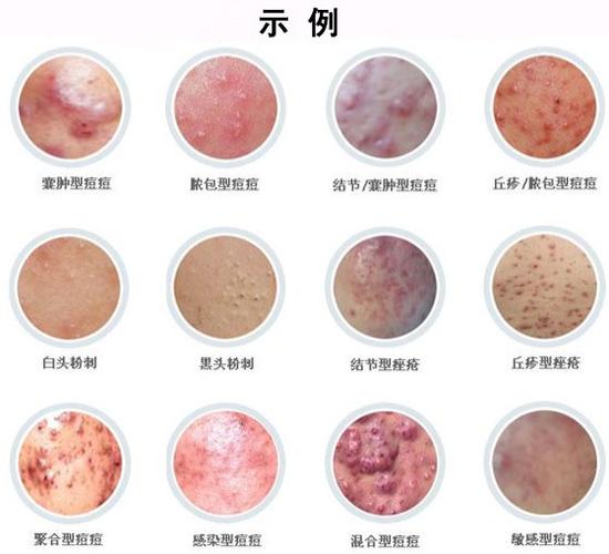 钟瑜琨老师分享几大痘痘形成原因解决痘痘