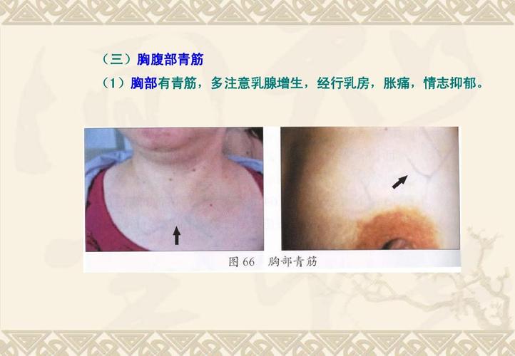 (三)胸腹部青筋 (1)胸部有青筋,多注意乳腺增生,经行乳房,胀痛,情志