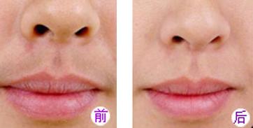 激光脱唇毛前后对比图