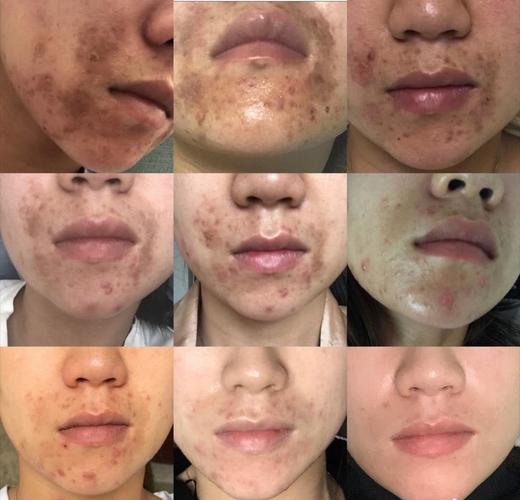 这种痘印该怎么消除啊,毛孔大,而且其实人很白,但是看上去很黑?