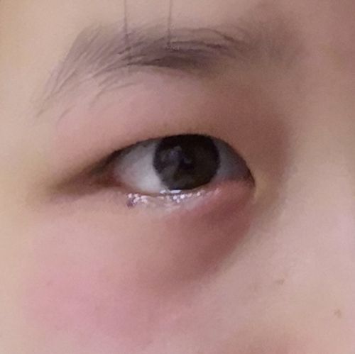 救命啊姐妹们 我这是得麦粒肿了吗