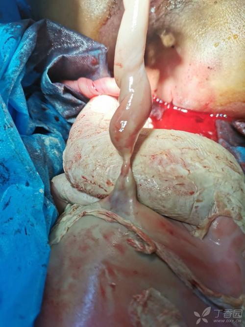 足月死胎,生下来发现了这个 [病例帖]