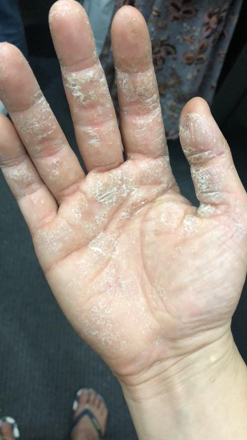 手足皲裂性湿疹 有没有人和我一样