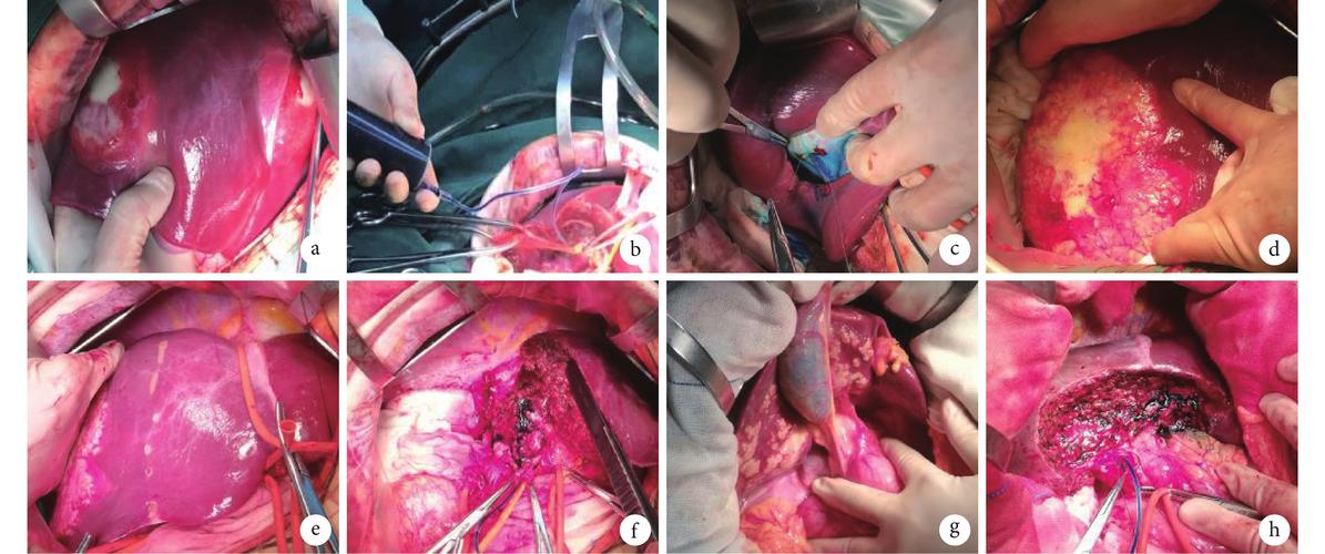 c:修补胆汁渗漏处;d:探查泡型肝包虫;e:解剖性右半肝切除;f:经胆囊管