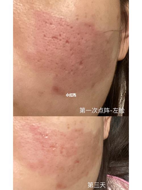 (痘坑毛孔比较大)终于做点阵了!