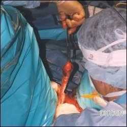 男人变女人 变性手术过程图示