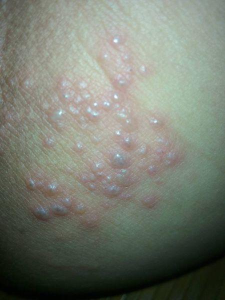 问:大腿根上长小水泡还痛是为什么