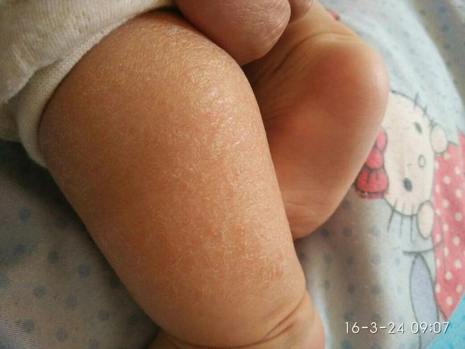 宝宝三个月皮肤干燥开裂,以前是一点,现在小腿一大片