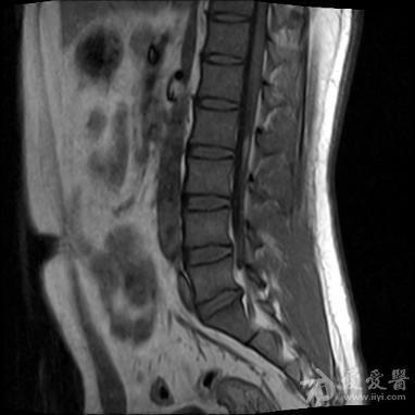脊髓终丝脂肪瘤