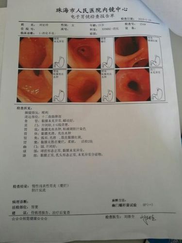 浅表性胃炎报告单图片