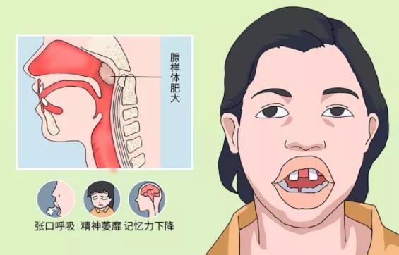 作为家长,如何自测孩子是否腺样体肥大呢?