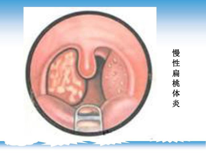 扁桃体炎( tonsillitis) 一,急性扁桃体炎 (acute tonsillitis)