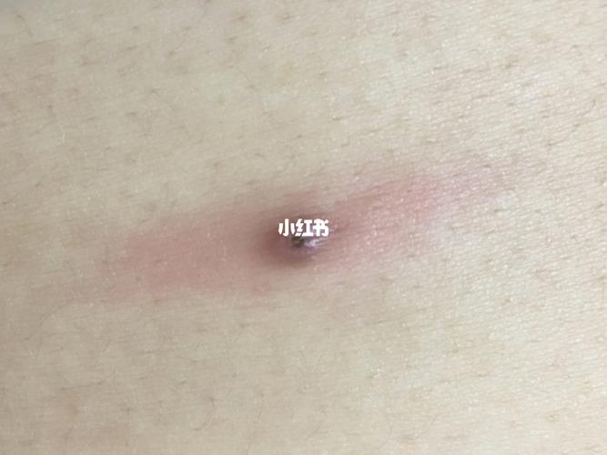 想知道这是什么长在肚子上04_痤疮_痘痘_痘痘痤疮_生活记录_日常