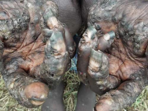 寄生虫病有多可怕