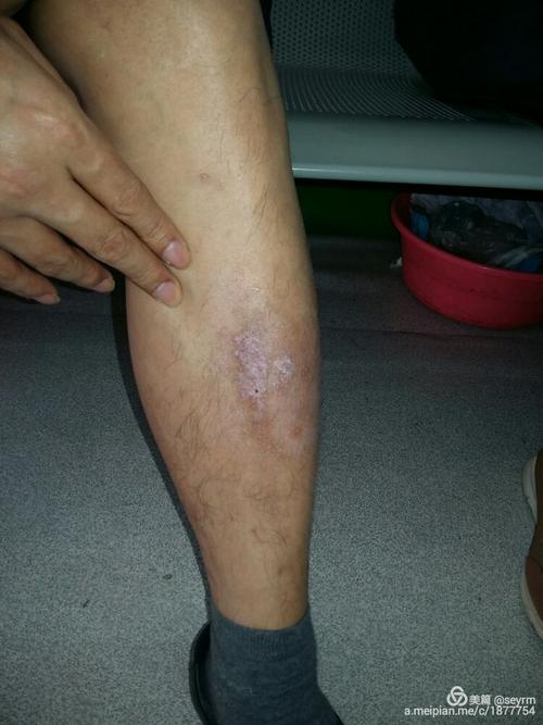 皮肤病展示图片