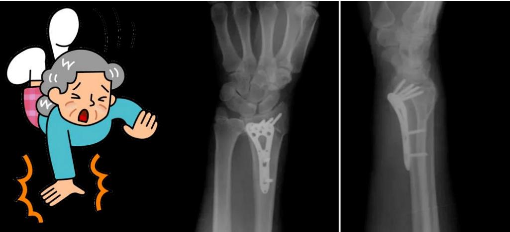 【医救治】骨质疏松要小心,老年桡骨远端骨折如何更快