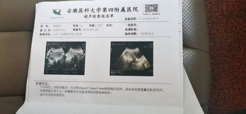 33天孕囊形状,请大师告知男女,谢谢