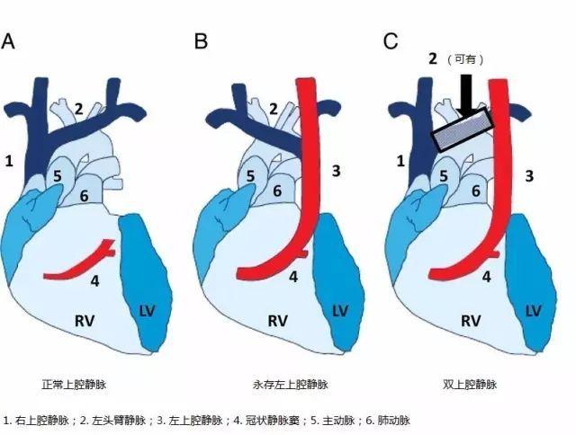 产科超声疑难病例429右上腔静脉缺如永存左上腔静脉入冠状静脉窦