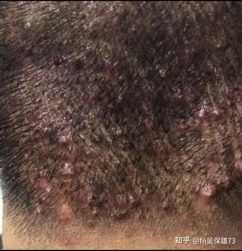 有什么可以彻底根治头皮毛囊炎的方法?