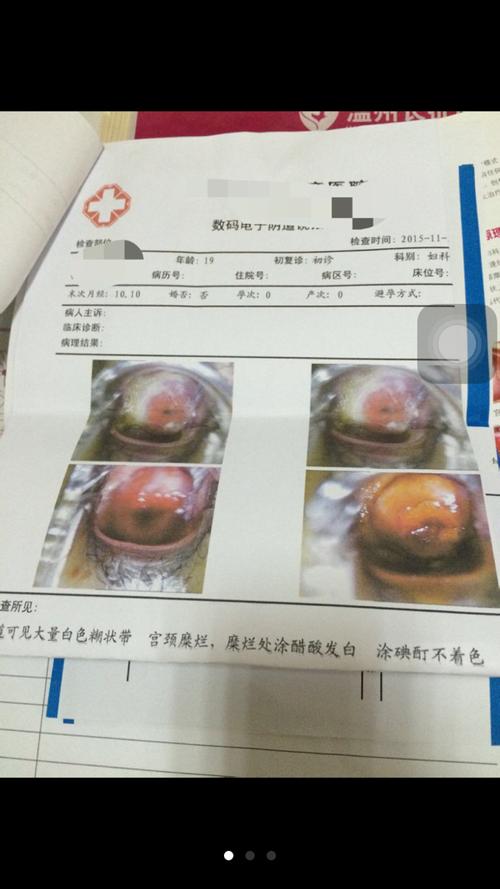 宫颈糜烂,糜烂处涂醋酸发白,涂碘酊不着色.是什么意思