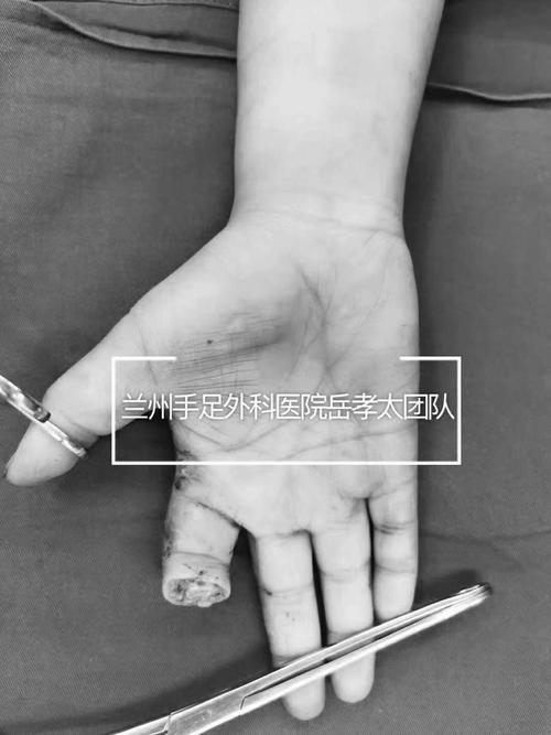 移花接木,指头搬家,今晚移植足第二趾再造右示指!