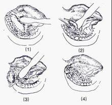 哑 铃型:口内舌下区及口外下颌下区均可见囊性肿物.