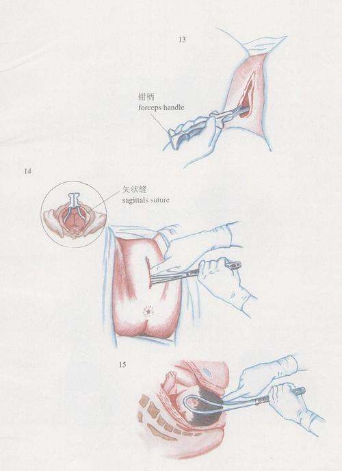 双叶产钳:亦是在切开子宫,破膜后施术,如胎头位置较高时,首先将胎头转