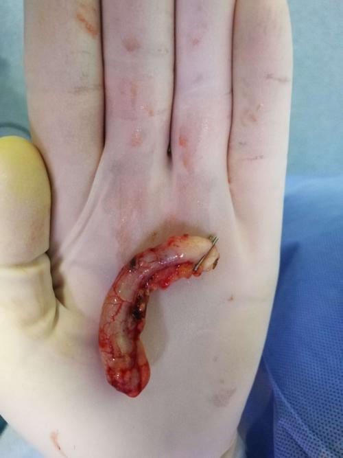 小胖阑尾,化脓性阑尾炎,内有粪石嵌顿.