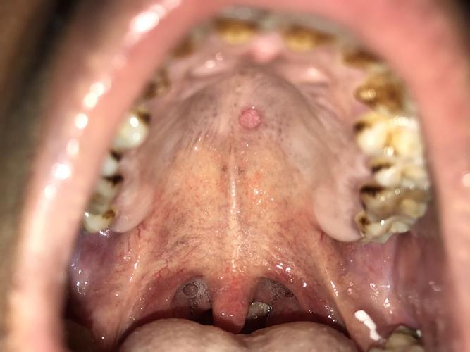 软腭长了一粒小肉粒,两年了还是这样不消,不痛也不痒.