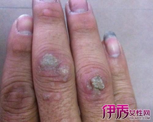 【图】鱼休子怎么治疗 六大方法有效治疗鱼休子