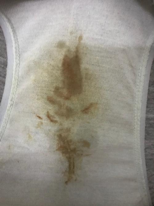 孕24周流褐色分泌物