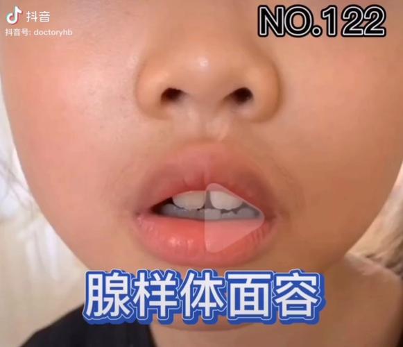 腺样体肥大宝宝的面容_腺样体肥大_母婴_育儿经验
