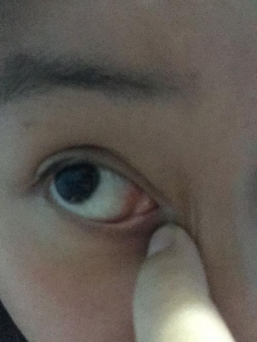 突然发现眼角位置有一块肉 感觉眼角都变大了 不知道是以前没发觉到