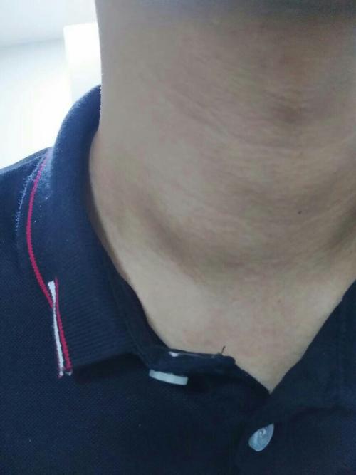 锁骨上面一点有个肿块,今天突然发现的,之前好像是没有的,摸着不痛也