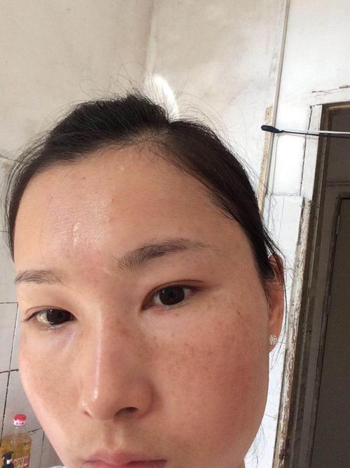 铅汞中毒斑的图片