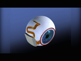 视网膜也可以人造?看这个技术如何帮助盲人重获光明!丨媞问创新