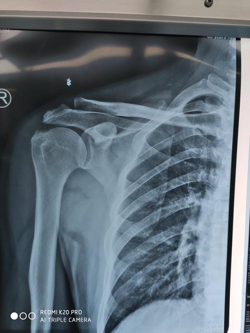 肩关节正位可见大结节,肩峰钙化,高密度影,提示肩峰撞击,术前未行肩胛