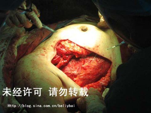 下面是今天普外科做的右侧乳腺癌根治术 乳房再造术.别吓到了!