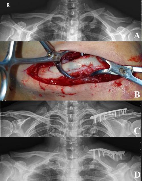 锁骨骨折:开放复位内固定与 mipo 固定同样安全有效